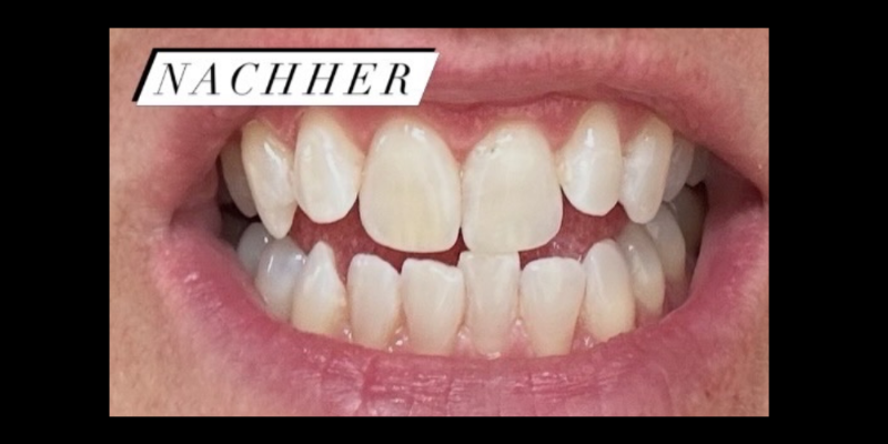 Nachher